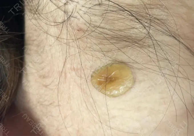 ほくろ・いぼ除去レーザー（肌） 美容皮膚科エルムクリニック 岡山院 DAY 9 メイン用