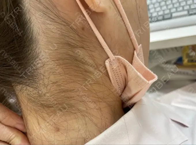 ほくろ・いぼ除去レーザー（肌） 美容皮膚科エルムクリニック 岡山院 AFTER メイン用