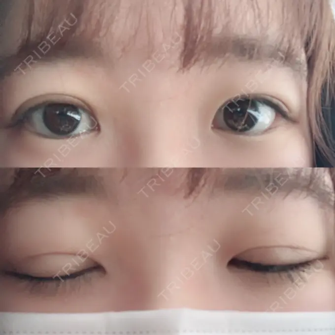 二重埋没 湘南美容クリニック 仙台院 DAY 14 メイン用