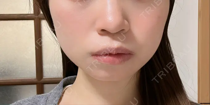 ボトックス（エラ・小顔） TCB東京中央美容外科 立川院 DAY 4 メイン用