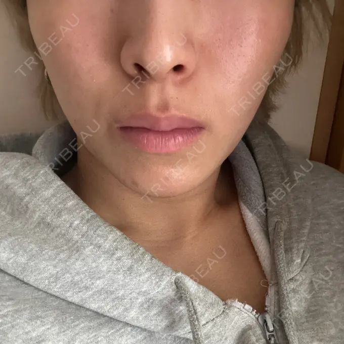 ボトックス（口角） / ボトックス（人中） しらゆりメディカルクリニック （旧しらゆりビューティークリニック） DAY 1 メイン用