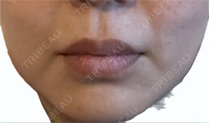 肌ヒアルロン酸注入（たるみ・シワ改善） / シワ取りボトックス TCB東京中央美容外科 福岡博多院 DAY 7 メイン用