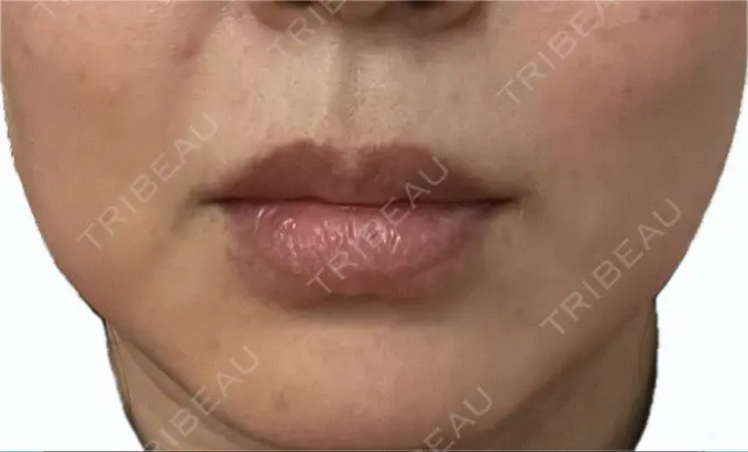 肌ヒアルロン酸注入（たるみ・シワ改善） / シワ取りボトックス TCB東京中央美容外科 福岡博多院 DAY 8 メイン用