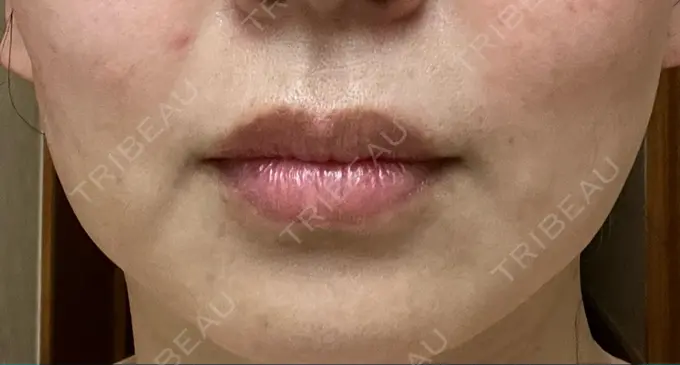 肌ヒアルロン酸注入（たるみ・シワ改善） / シワ取りボトックス TCB東京中央美容外科 福岡博多院 DAY 9 メイン用