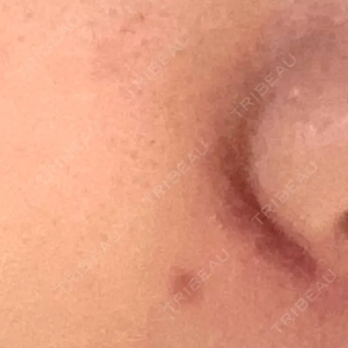 ほくろ・いぼ切除（肌） ルラ美容クリニック 広島院 DAY 26 メイン用