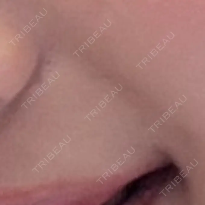 ほくろ・いぼ切除（肌） ルラ美容クリニック 広島院 AFTER メイン用