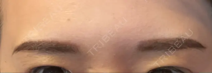 アートメイク（眉） Tokyo Tensei Clinic 新宿院 DAY 2 メイン用