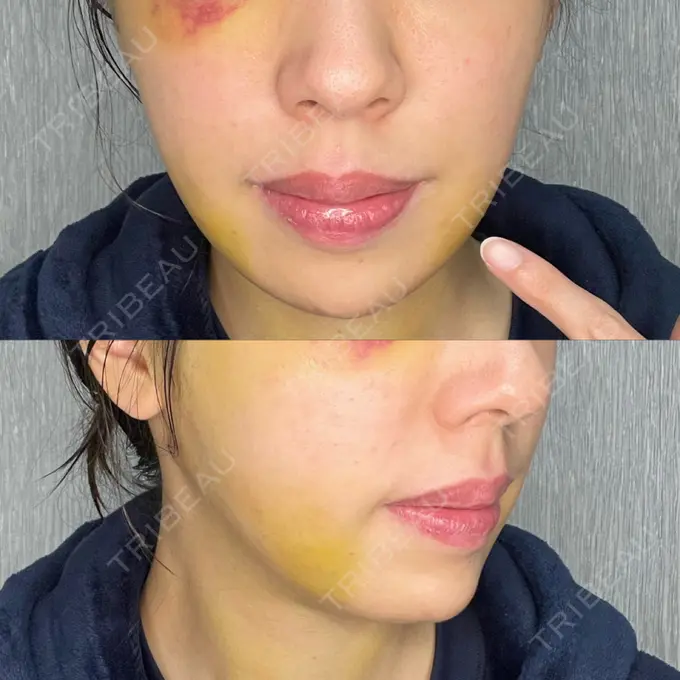 糸リフト / 脂肪吸引（顔） / ジョールファット除去 / ボトックス（あご） / ヒアルロン酸注入（あご） / ボトックス（エラ・小顔） RIVER CLINIC（リバークリニック） DAY 6 メイン用