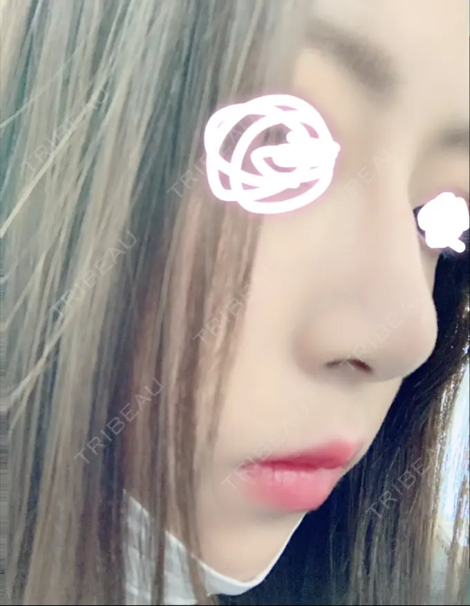 レディエッセ注入（鼻） トアロード形成美容クリニック AFTER メイン用