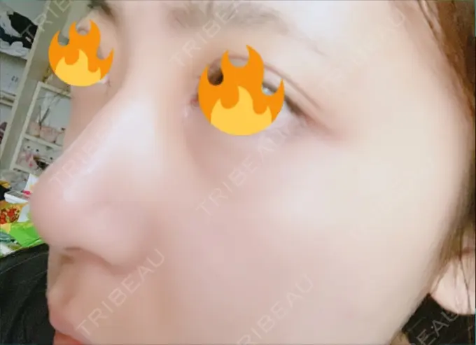 レディエッセ注入（鼻） トアロード形成美容クリニック DAY 11 メイン用