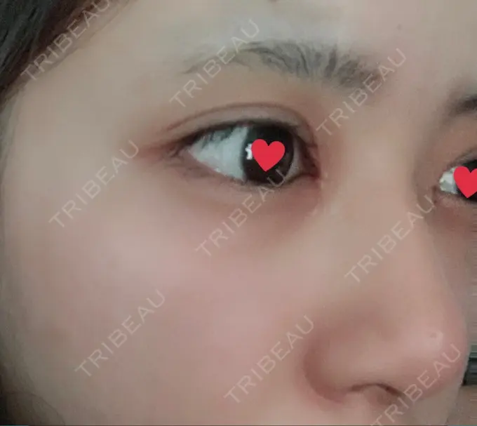 レディエッセ注入（鼻） トアロード形成美容クリニック DAY 11 メイン用