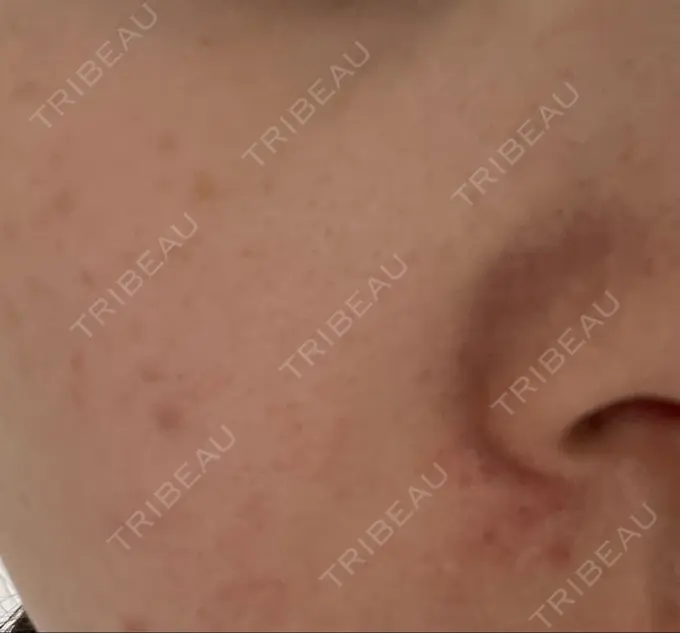 光治療（フォトフェイシャルなど） 新宿美容外科クリニック 新宿院 DAY 1 メイン用