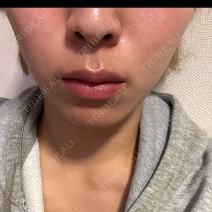 ボトックス（口角） / ボトックス（人中） しらゆりメディカルクリニック （旧しらゆりビューティークリニック） DAY 2 メイン用