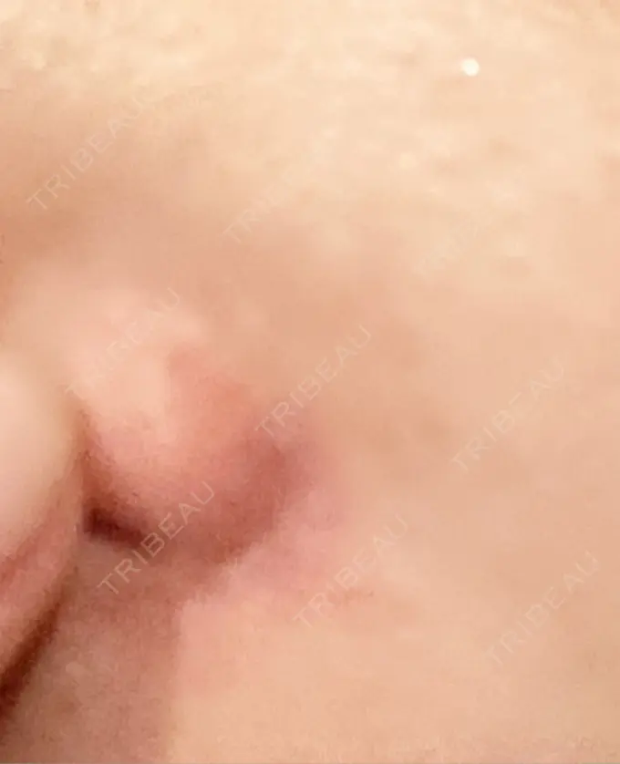 小鼻縮小（非切開） TCB東京中央美容外科 世田谷院 DAY 5 メイン用