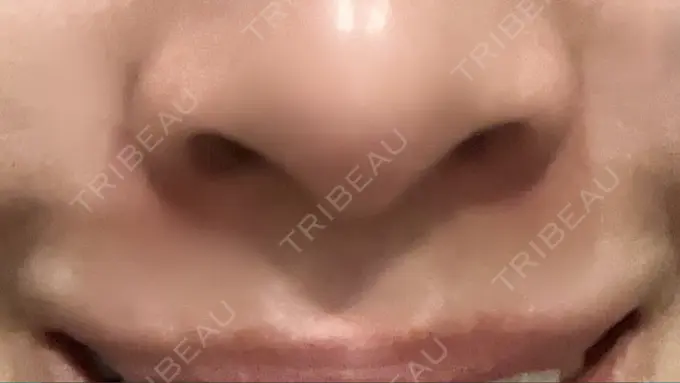 小鼻縮小（非切開） TCB東京中央美容外科 世田谷院 DAY 5 メイン用