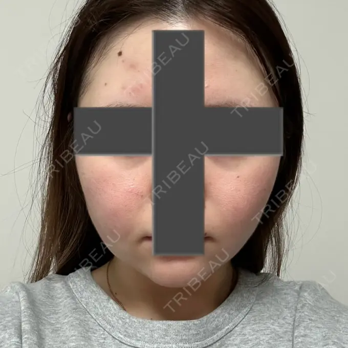 脂肪吸引（顔） / ジョールファット除去 / ヒアルロン酸注入（あご） / ボトックス（エラ・小顔） Otus Clinic 【オータスクリニック】 DAY 45 メイン用