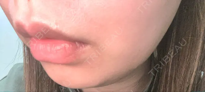 脂肪溶解注射（顔） 表参道ウィズ・クリニック AFTER メイン用