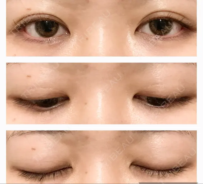 二重埋没 水の森美容クリニック 東京銀座院 DAY 60 メイン用