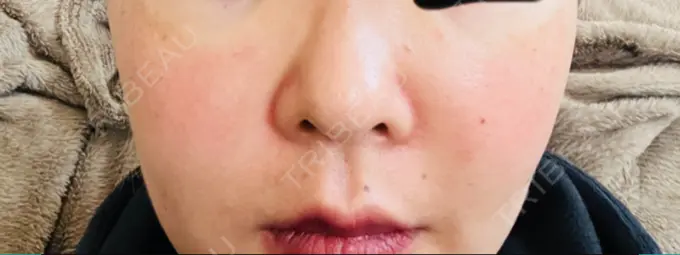 クマ治療 / 脂肪溶解注射（顔） / その他（鼻） TCB東京中央美容外科 京都四条院 DAY 0 メイン用