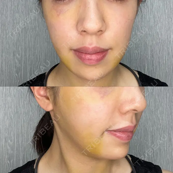 糸リフト / 脂肪吸引（顔） / ジョールファット除去 / ボトックス（あご） / ヒアルロン酸注入（あご） / ボトックス（エラ・小顔） RIVER CLINIC（リバークリニック） DAY 8 メイン用