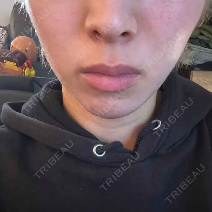 ボトックス（口角） / ボトックス（人中） しらゆりメディカルクリニック （旧しらゆりビューティークリニック） DAY 4 メイン用