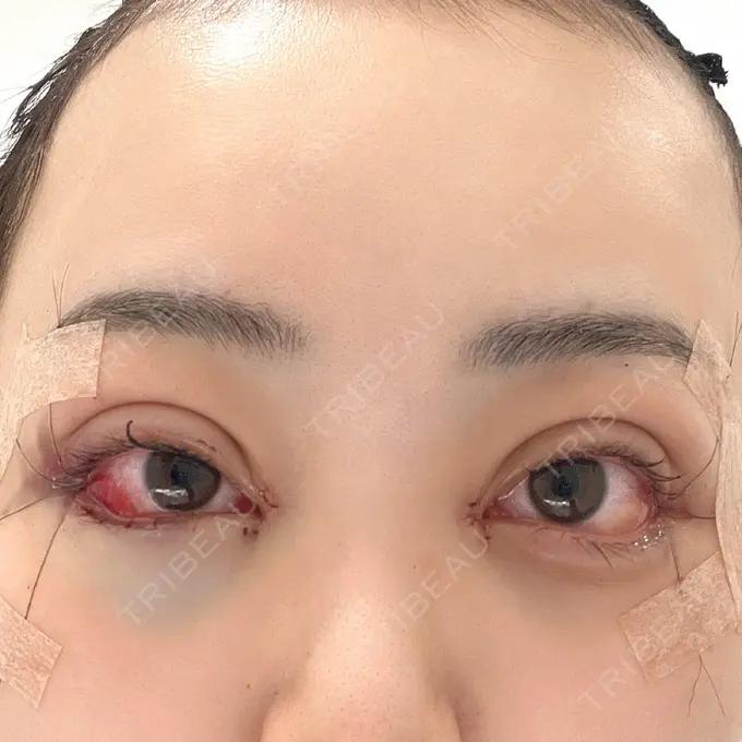 二重埋没 / 目頭切開 / クマ治療 / 目尻切開 / タレ目形成・グラマラスライン（切開） EMMA CLINIC（エマクリニック） DAY 0 メイン用