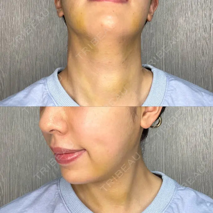 糸リフト / 脂肪吸引（顔） / ジョールファット除去 / ボトックス（あご） / ヒアルロン酸注入（あご） / ボトックス（エラ・小顔） RIVER CLINIC（リバークリニック） DAY 10 メイン用