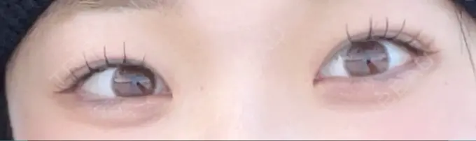 二重埋没 / 目頭切開 くさのたろうクリニック AFTER メイン用