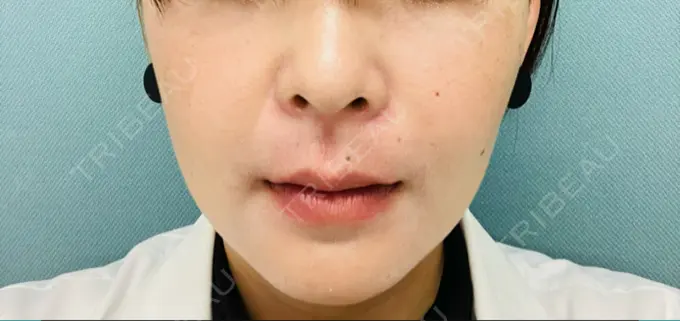 クマ治療 / 脂肪溶解注射（顔） / その他（鼻） TCB東京中央美容外科 京都四条院 AFTER メイン用