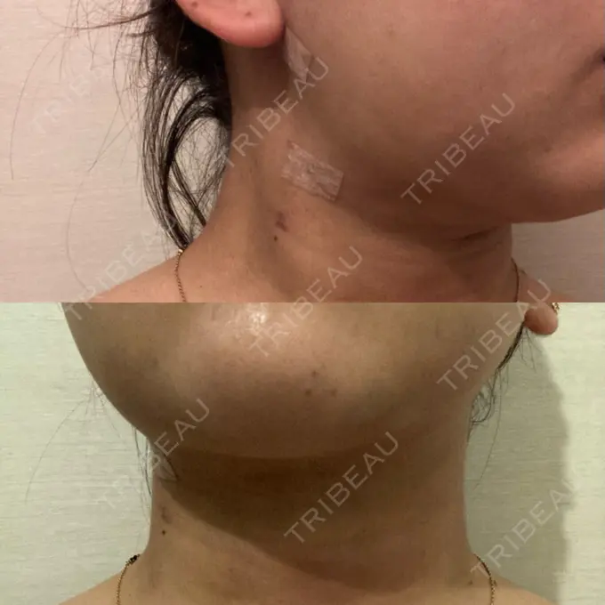 糸リフト / 脂肪吸引（顔） / ボトックス（エラ・小顔） 湘南美容クリニック 秋葉原院 DAY 8 メイン用