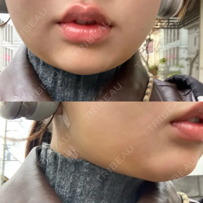 糸リフト / 脂肪吸引（顔） / ボトックス（エラ・小顔） 湘南美容クリニック 秋葉原院 DAY 11 メイン用