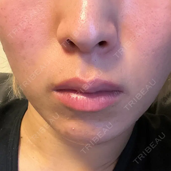 ボトックス（口角） / ボトックス（人中） しらゆりメディカルクリニック （旧しらゆりビューティークリニック） AFTER メイン用