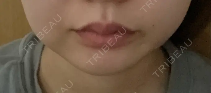 脂肪吸引（顔） 大塚美容形成外科 金沢院 AFTER メイン用