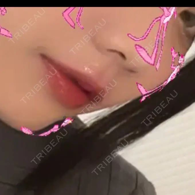 鼻中隔延長（非切開） / ボトックス（エラ・小顔） TCB東京中央美容外科 町田院 DAY 10 メイン用