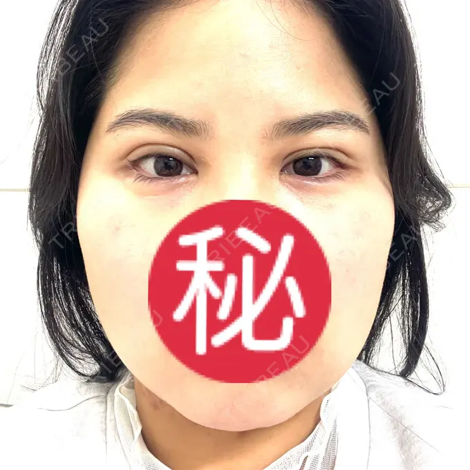 二重埋没 / 糸リフト / 脂肪吸引（顔） / ヒアルロン酸注入（涙袋） / ピアス穴あけ ルラ美容クリニック 大阪本院 DAY 11 メイン用