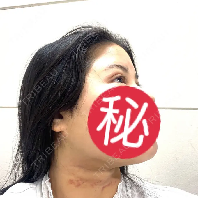 二重埋没 / 糸リフト / 脂肪吸引（顔） / ヒアルロン酸注入（涙袋） / ピアス穴あけ ルラ美容クリニック 大阪本院 DAY 11 メイン用