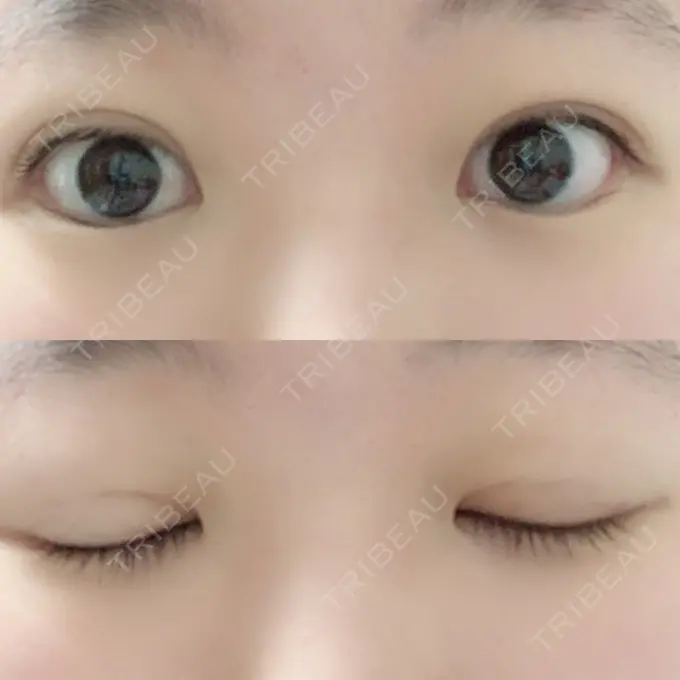 二重埋没 湘南美容クリニック 仙台院 AFTER メイン用