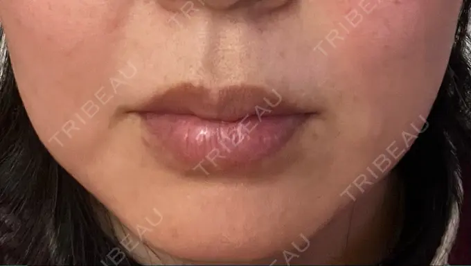 肌ヒアルロン酸注入（たるみ・シワ改善） / シワ取りボトックス TCB東京中央美容外科 福岡博多院 AFTER メイン用