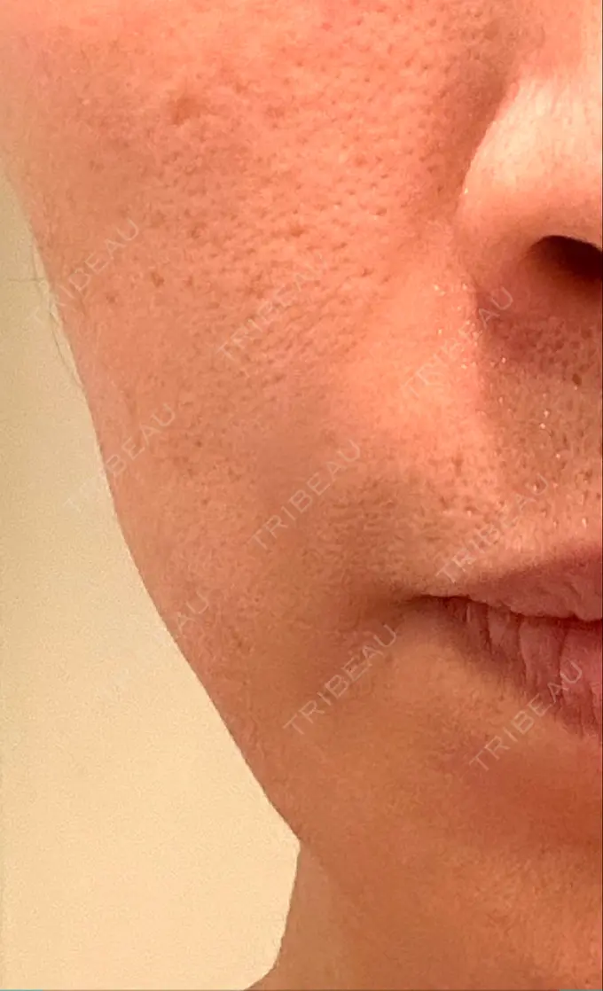 脂肪注入（肌） 湘南美容クリニック 秋葉原院 AFTER メイン用