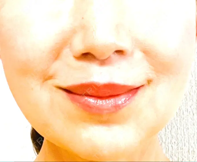 小鼻縮小（切開） / 人中短縮 Otus Clinic 【オータスクリニック】 DAY 255 メイン用