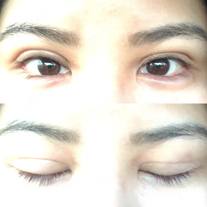 二重埋没 / 糸リフト / 脂肪吸引（顔） / ヒアルロン酸注入（涙袋） / ピアス穴あけ ルラ美容クリニック 大阪本院 DAY 13 メイン用