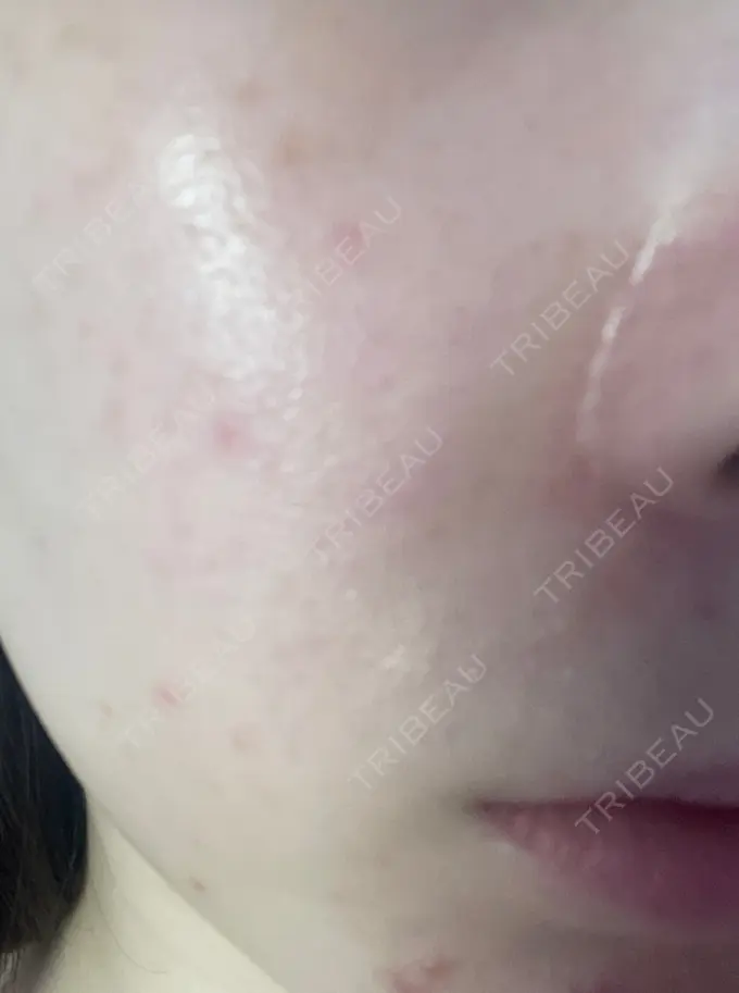 光治療（フォトフェイシャルなど） 新宿美容外科クリニック 新宿院 DAY 7 メイン用