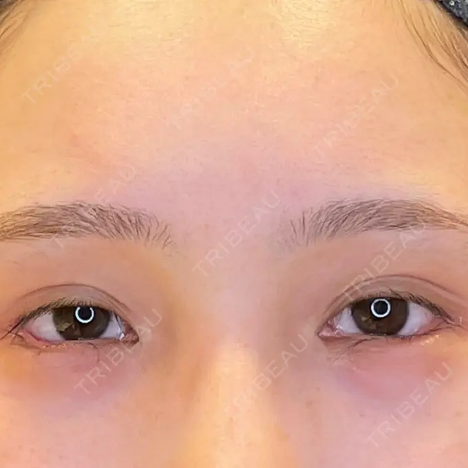 目尻切開 / タレ目形成・グラマラスライン（埋没） LOUIS CLINIC 二子玉川院【ルイクリニック】 DAY 0 メイン用