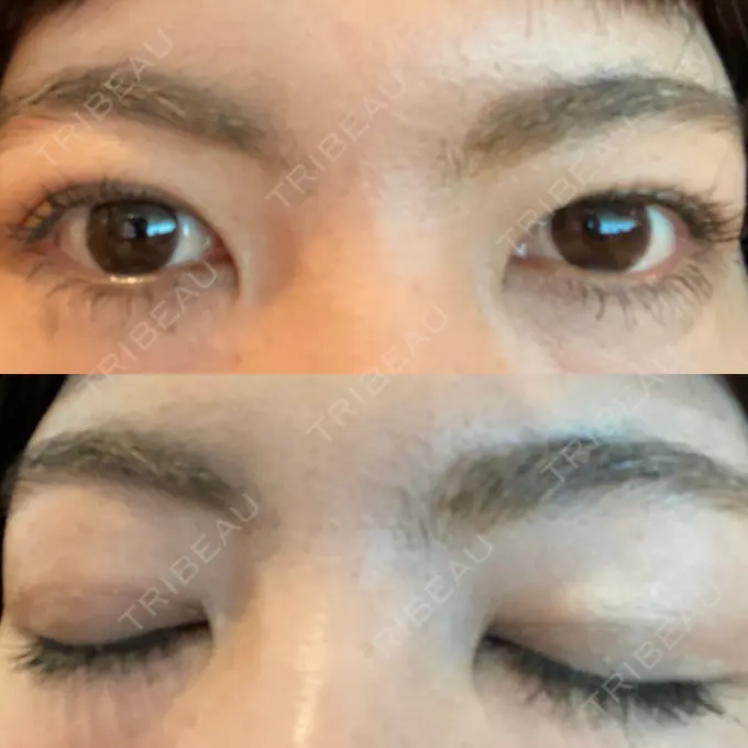 二重埋没 湘南美容クリニック 京都院 AFTER メイン用