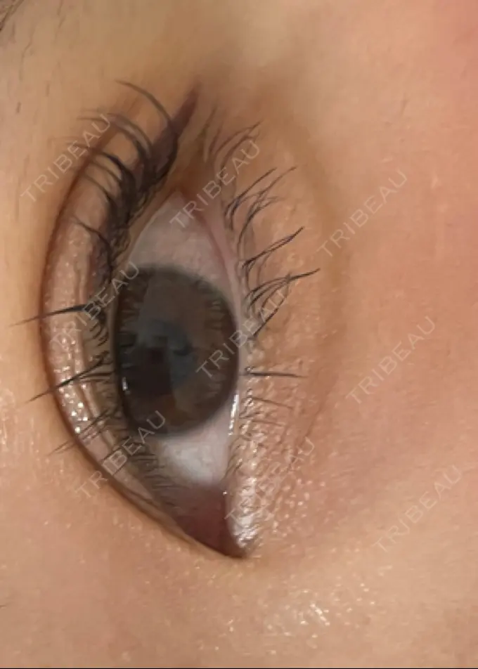 二重埋没 城本クリニック 福岡院 AFTER メイン用