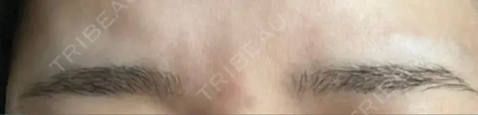 ボトックス（あご） / ボトックス（眉間） 湘南美容クリニック 京都院 AFTER メイン用