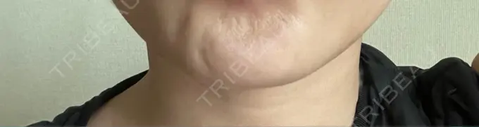 ボトックス（あご） / ボトックス（眉間） 湘南美容クリニック 京都院 DAY 14 メイン用