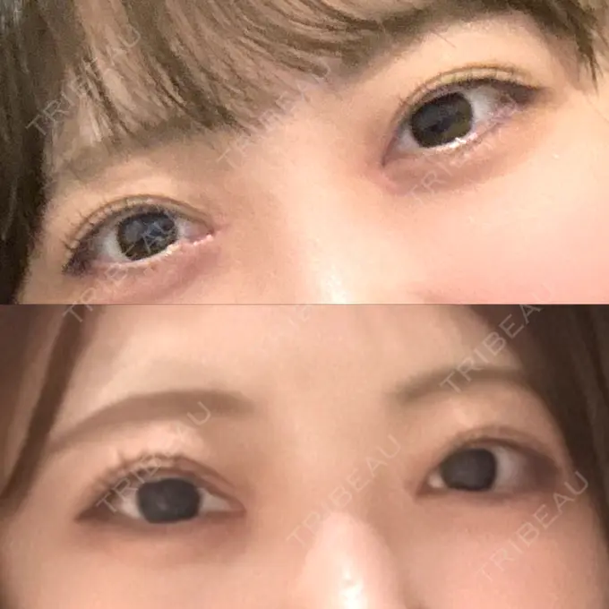 二重埋没 / 目頭切開 AI Beauty Clinic （エーアイ美容クリニック） AFTER メイン用