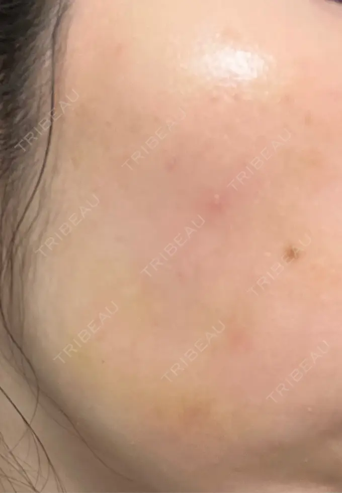 ハイフ（顔） 椿クリニック 心斎橋院 DAY 6 メイン用