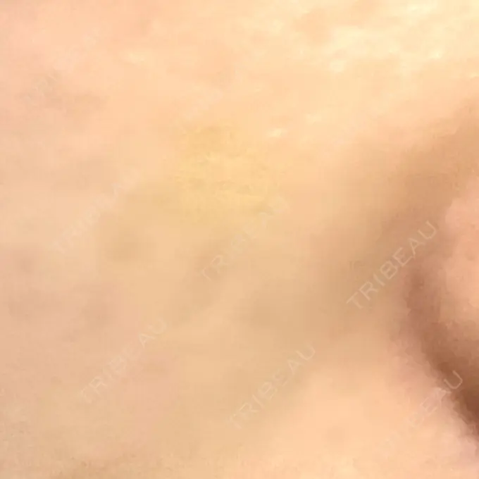 小鼻縮小（非切開） TCB東京中央美容外科 世田谷院 DAY 12 メイン用